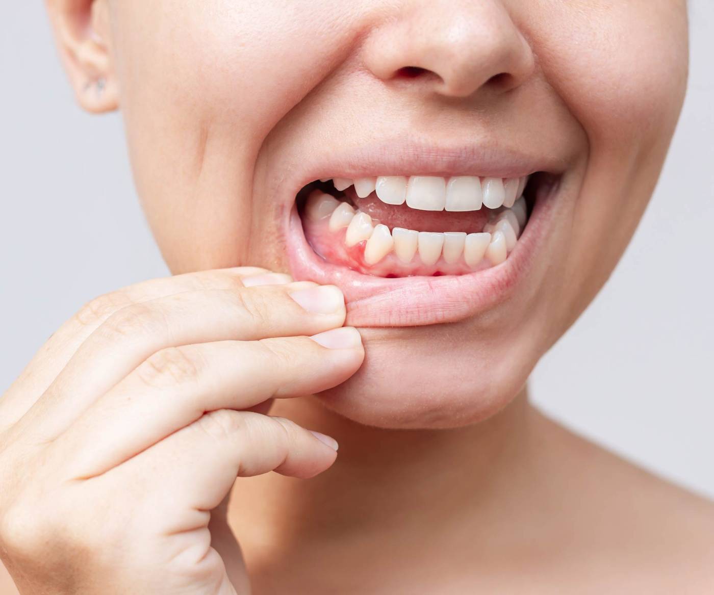 Medical-san-giorgio-dentista-cantù-TRATTAMENTO-infiammazione-tessuto-gengivale