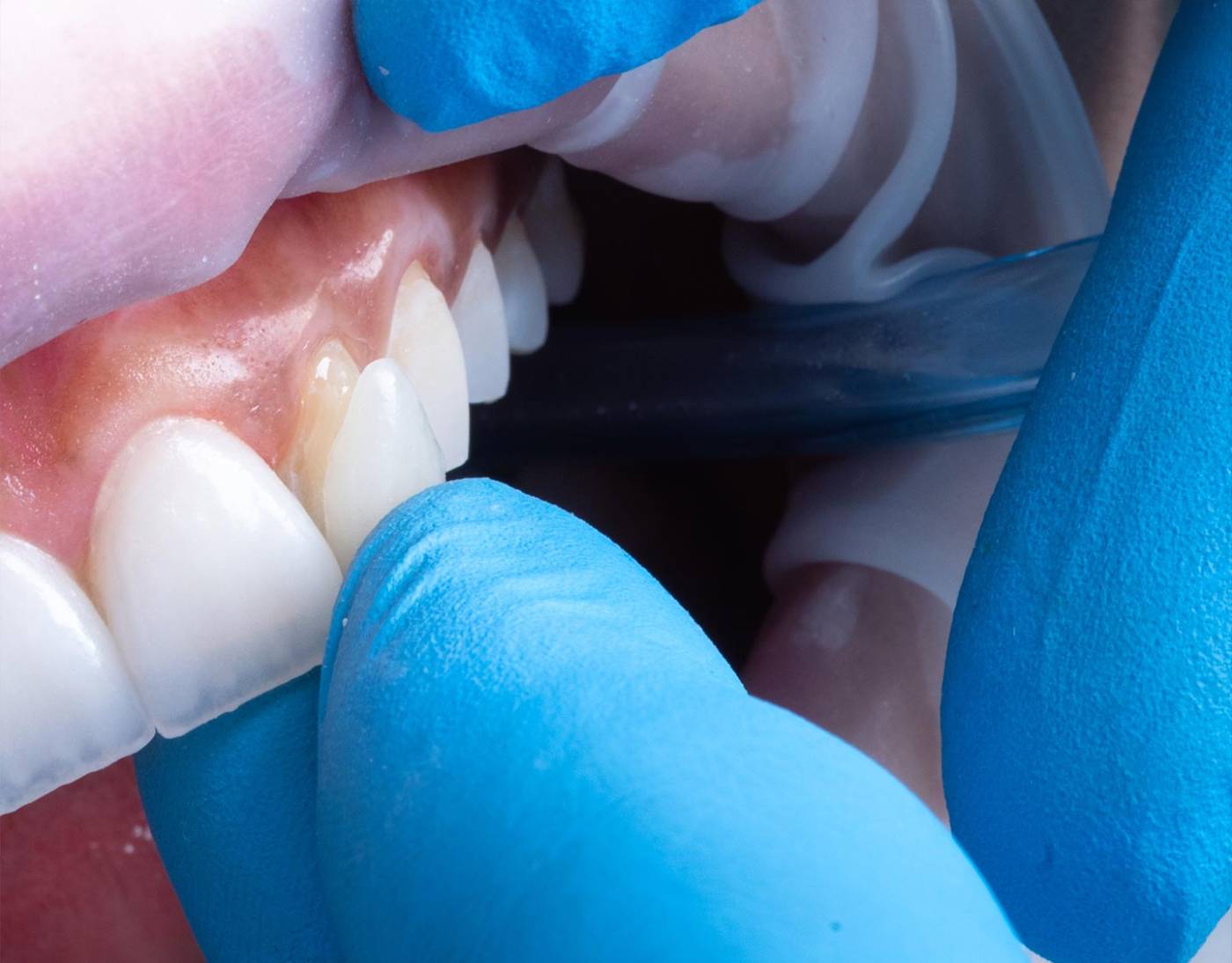 Medical-san-giorgio-dentista-cantu-terapie-odontoiatria-faccette-dentali