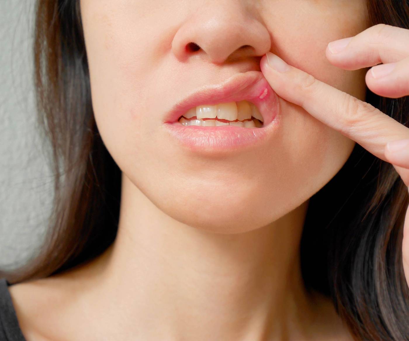 Medical-san-giorgio-dentista-cant&ugrave;-TRATTAMENTO-afte-herpes